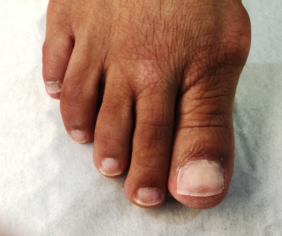 Toenail Reconstructions - kingstonfeet