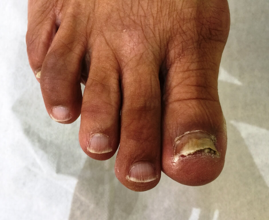 Toenail Reconstructions - kingstonfeet