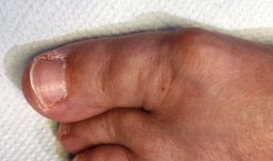 A foot with bunions