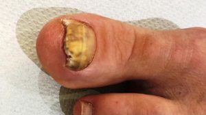 A toenail with a fungal infection