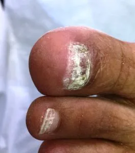 A toenail needing reconstruction