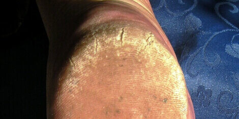 Cracked skin on the heel