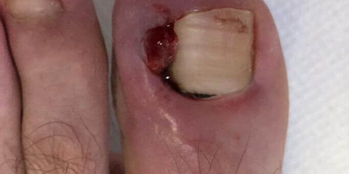 An ingrowing toenail